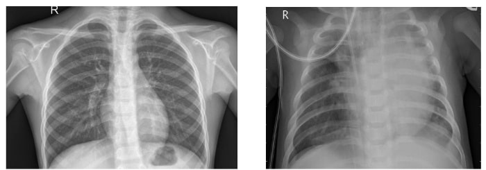 The image on the left shows a normal chest X-ray, whereas the one on the right shows lungs with pneumonia opacity.